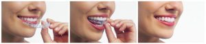 invisalign teeth straightening trays