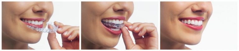 invisalign teeth straightening trays